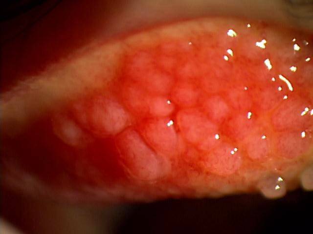 巨大乳頭結膜炎